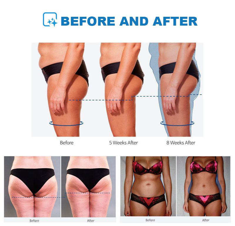 Elektromanyetik 4 Başlıklı Ems - Ems Body Sculpting Machine Emslim incelemesi ve fiyatı
